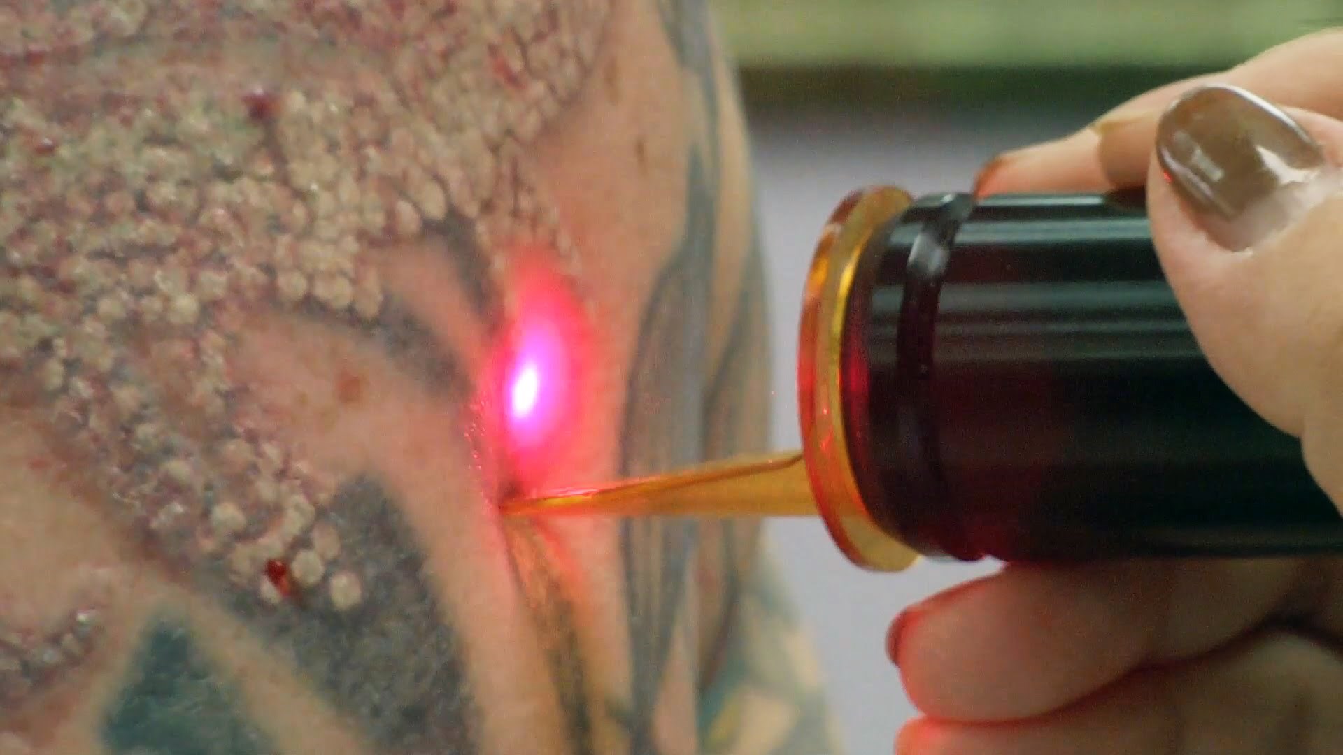 Βαρεθήκατε το τατουάζ σας; Δείτε πώς γίνεται αφαίρεση με λέιζερ – ΒΙΝΤΕΟ