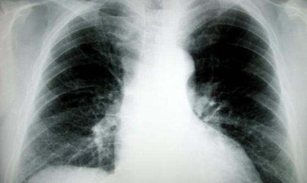 Μία τρύπα στο νερό έκανε ο αντικαπνιστικός νόμος