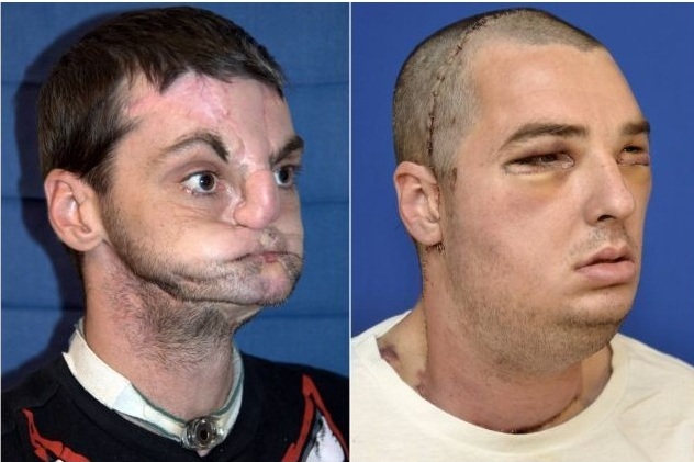 Απίθανη μεταμόσχευση