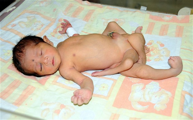 Μωρό γεννήθηκε με έξι πόδια