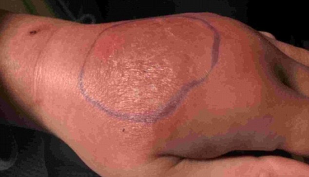 Χάνει το χέρι της από αράχνη