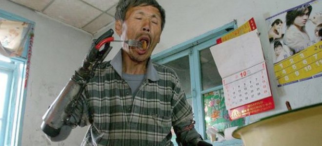 Έφτιαξε μόνος του βιονικά χέρια