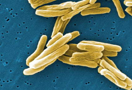 Αύξηση στα κρούσματα φυματίωσης