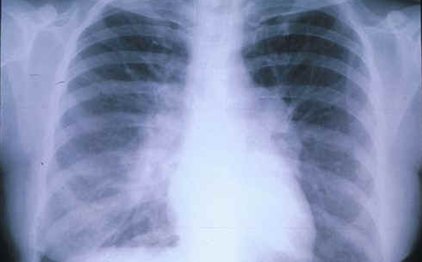 Ελπίδες για τον καρκίνο