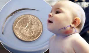 Έβγαλαν φτερό από μάγουλο μωρού