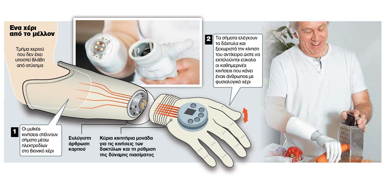 Νέα ζωή με το βιονικό «Χέρι του Μιχαήλ Αγγελου»