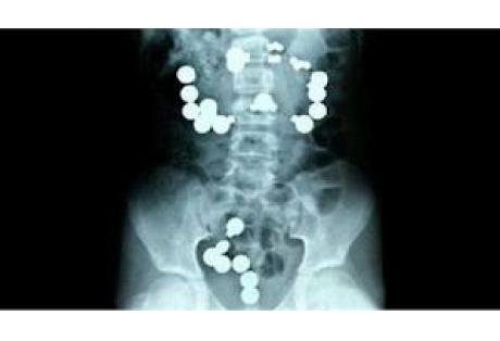 Βρέφος κατάπιε 42 μαγνητάκια ψυγείου