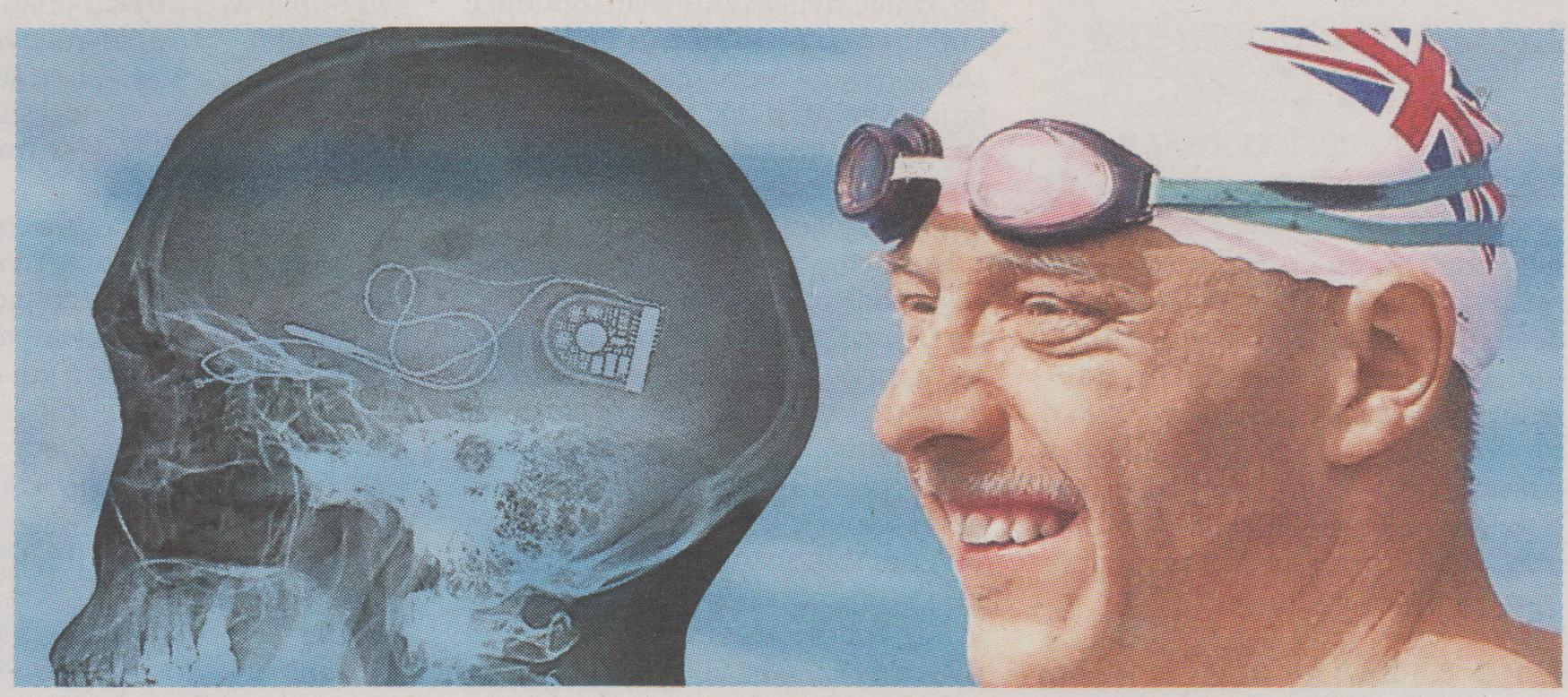 Ένα μικροτσίπ του έδωσε το φως του