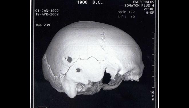 Στους Δελφούς η πρώτη επέμβαση εγκεφάλου