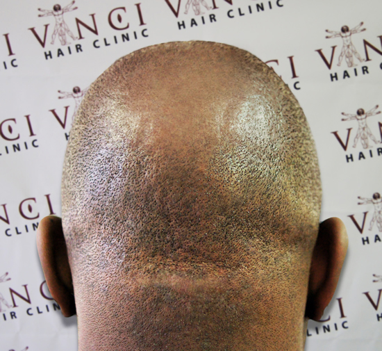 ΦΩΤΟ-Φαλάκρα τέλος με τατουάζ μαλλιών