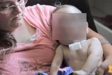 Σώθηκε μωρό με 3D εκτύπωση οργάνου