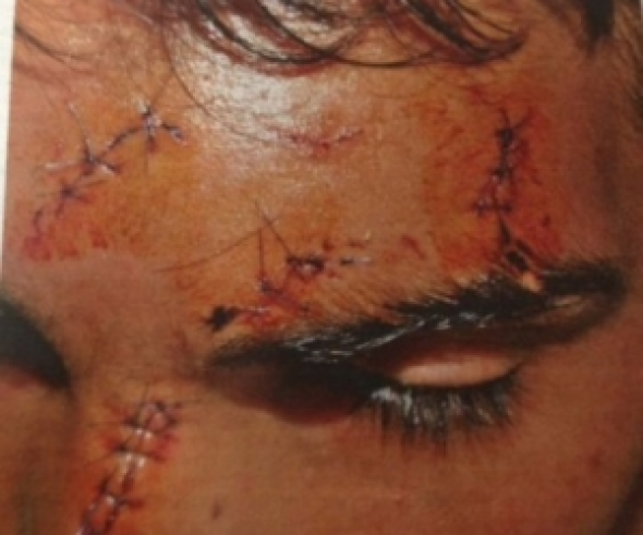 ΒΙΝΤΕΟ- Ο 14χρονος μιλάει για τη ρατσιστική επίθεση