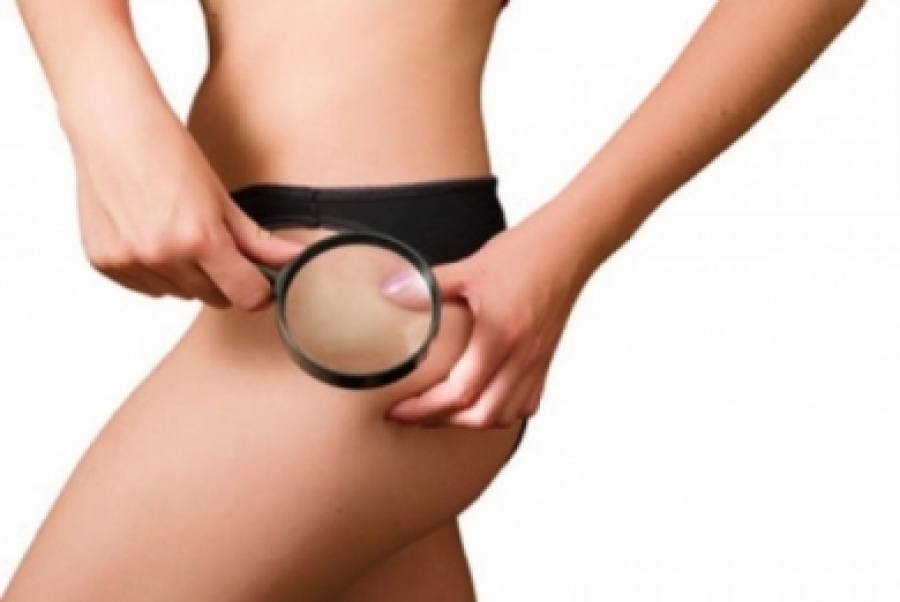 10 ερωτήσεις για την κυτταρίτιδα