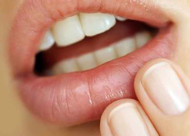 Πόσο επικίνδυνος είναι ο επιχείλιος έρπης;