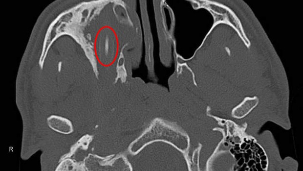 Ζούσε 15 χρόνια με ένα μολύβι στο κεφάλι του