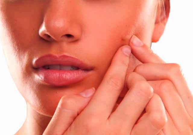 Πού οφείλεται η ακμή στους ενήλικες;