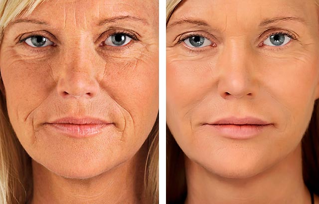 Υαλουρονικό οξύ: Χρήσιμες συμβουλές για την “πηγή νεότητας”