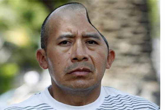 Αποζημίωση σε άνδρα με μισό κρανίο