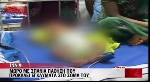 ΒΙΝΤΕΟ-βρέφος που αυταναφλέγεται