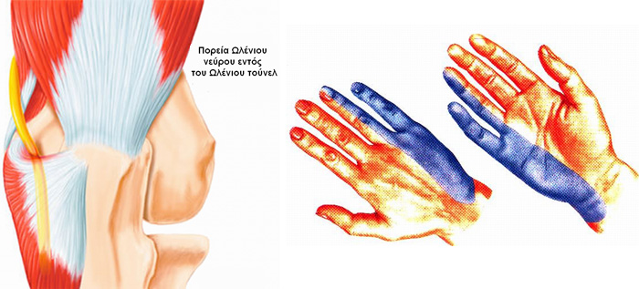 Ωλένια Νευρίτιδα: Συμπτώματα και θεραπεία