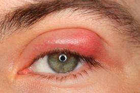 Τι είναι και πώς θεραπεύεται το χαλάζιο στα μάτια;