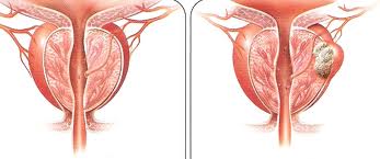 Οι τελευταίες εξελίξεις για τον καρκίνο του προστάτη