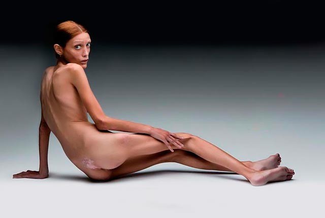 Ανορεξία: Τι να σε ανησυχήσει