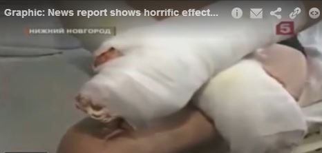 ΦΩΤΟ-Krokodil: Ναρκωτικό που τρώει τη σάρκα!