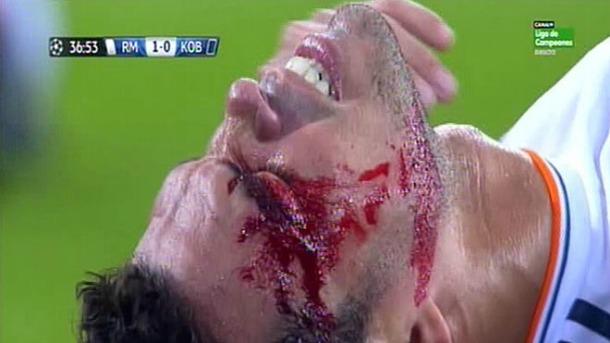 ΒΙΝΤΕΟ-Ο σοβαρός τραυματισμός του Πέπε