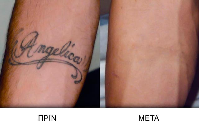 Μετάνιωσες για το τατουάζ;Μάθε για τη διαδικασία αφαίρεσης