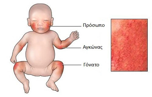 Αντιμετώπιση της ατοπικής δερματίτιδας
