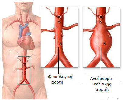 Ανευρύσματα κοιλιακής αορτής