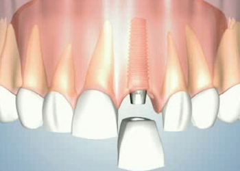 Γιατί να επιλέξω οδοντικά εμφυτεύματα;