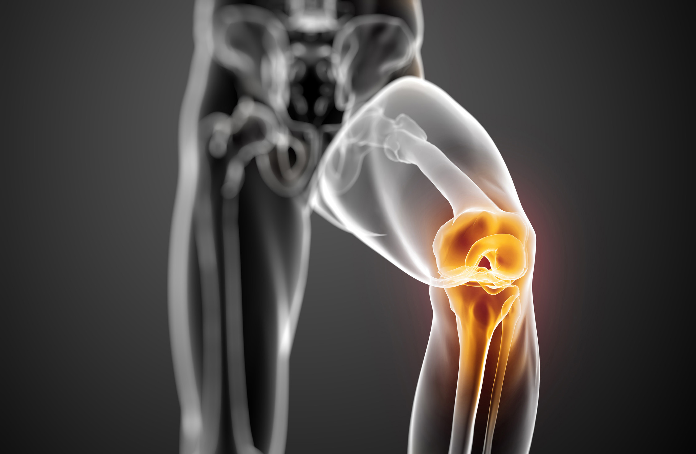 Τι προκαλεί την αρθρίτιδα γόνατος;