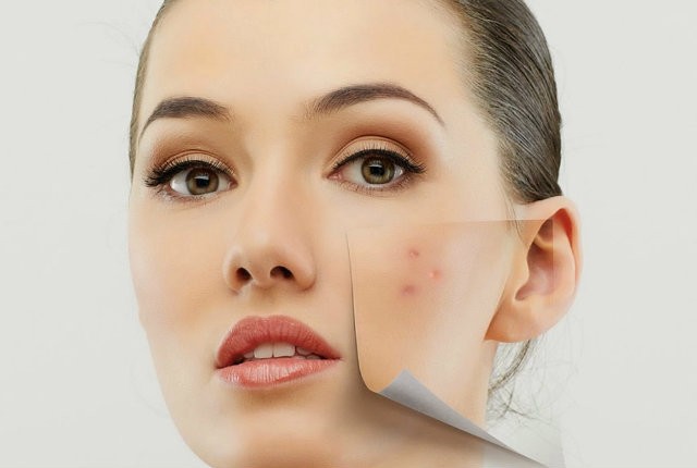 Πως θα εξαφανίσεις τις ουλές από ακμή