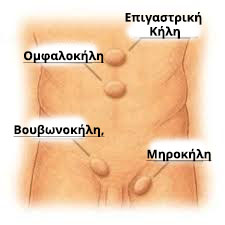 Αναίμακτη και ανώδυνη μέθοδος αντιμετώπισης της κήλης