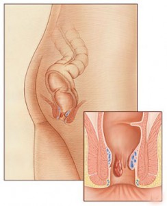 Αιμορροΐδες: Οριστική λύση σε ένα πρόβλημα ταμπού