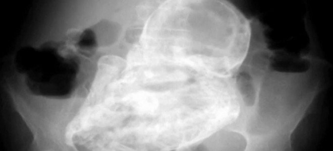 ΒΙΝΤΕΟ- κυοφορούσε έμβρυο 40 ετών