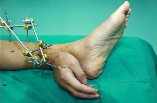 Του μεταμόσχευσαν το χέρι στη γάμπα