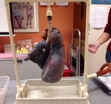 ΒΙΝΤΕΟ-Ετσι είναι οι πνεύμονες των καπνιστών