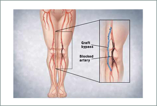 Παθήσεις αρτηριών: Η αιτία και οι παράγοντες κινδύνου