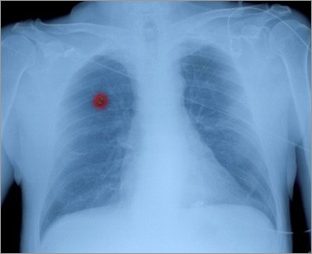 Συχνές ερωτήσεις και απαντήσεις για τον καρκίνο του πνεύμονα