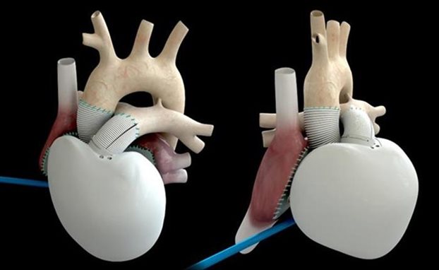 Τεχνητή καρδιά αντί για μεταμόσχευση
