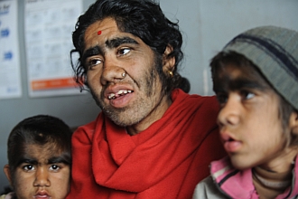 Οικογένεια… λυκανθρώπων ζει στο Νεπάλ