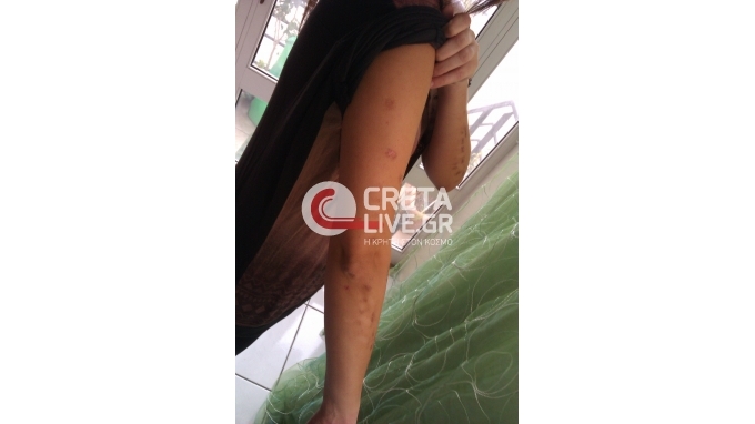 Πήγε για αποτρίχωση και βγήκε με εγκαύματα