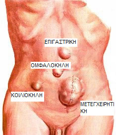 Κήλη: Πότε πρέπει να αντιμετωπίζεται;