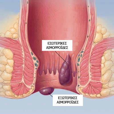 Η χειρουργική θεραπεία των αιμορροΐδων