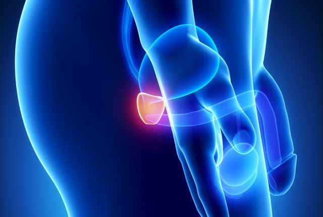 Tεστ αποκαλύπτει ποιοι κινδυνεύουν από καρκίνο του προστάτη