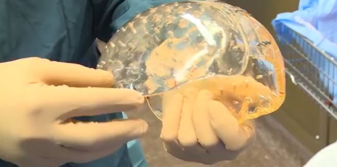 Πρωτοποριακή επέμβαση με μόσχευμα από 3D εκτυπωτή