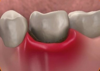 Αιμορραγία των ούλων. Πότε είναι επικίνδυνη;